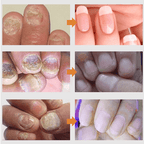 Efero Spray - Restaura Unhas e Elimina Fungos