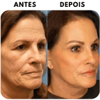 Creme Celyn - Levanta Pálpebras Caídas e Reduz Rugas Dos Olhos